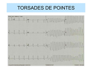 TORSADES DE POINTES
 