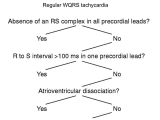 Regular WQRS tachycardia 