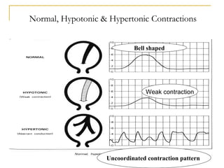 Wiki.assessment of uterine contractions 2011