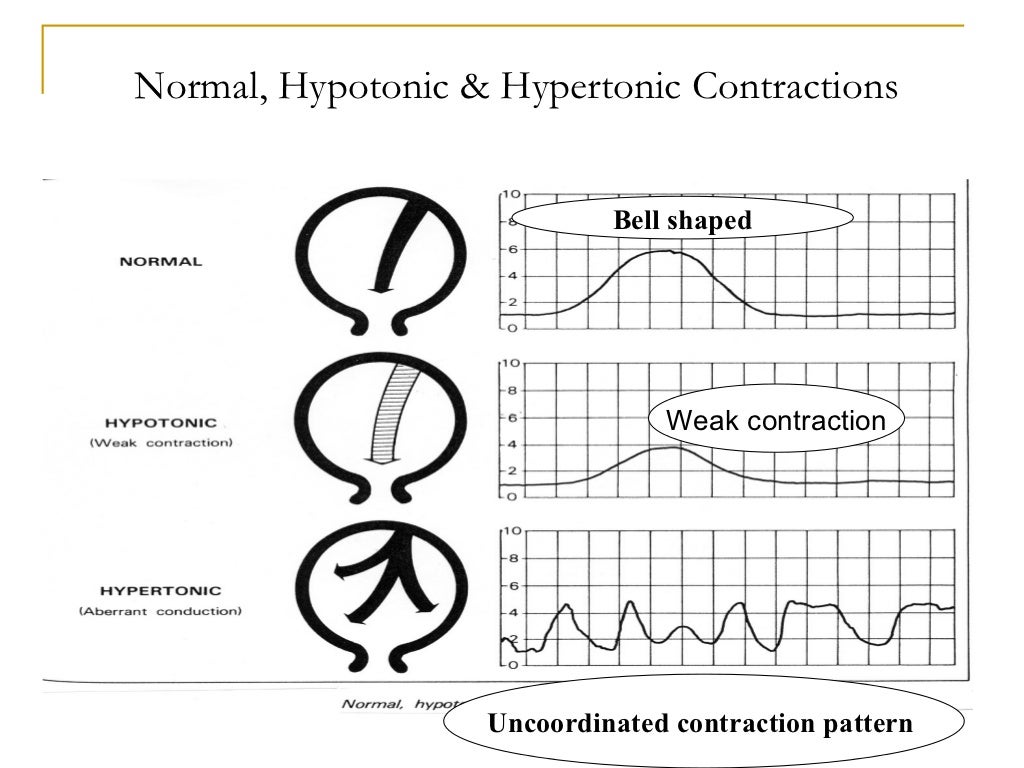 Wiki.assessment of uterine contractions 2011