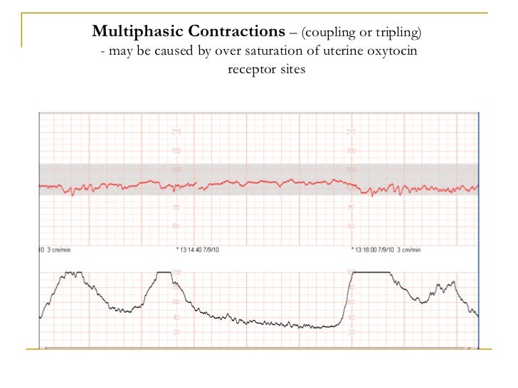 Wiki.assessment of uterine contractions 2011