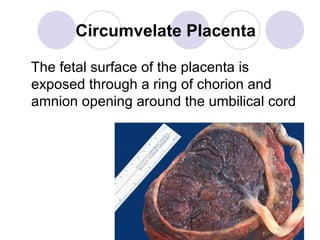 Chorionic Ring Wiki.placental abnormalities1 | PPT
