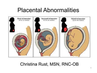 Placental Abnormalities




 Christina Rust, MSN, RNC-OB
                               1
 