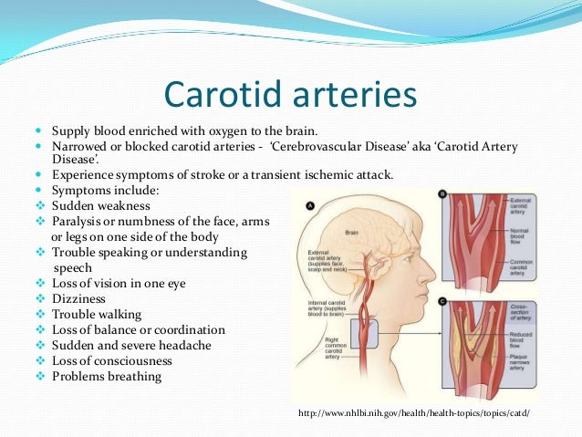 What are some symptoms of carotid artery disease?