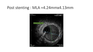Post stenting : MLA =4.24mmx4.13mm
 