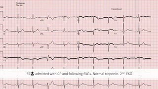 57👩 admitted with CP and following EKGs. Normal troponin. 2nd EKG
 