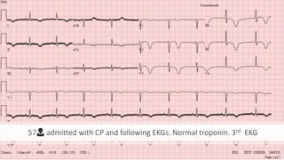 57👩 admitted with CP and following EKGs. Normal troponin. 3rd EKG
 