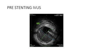 PRE STENTING IVUS
 