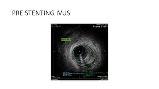 PRE STENTING IVUS
 
