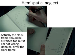 Hemispatial neglect
Actually the clock
frame should be
distorted too but if
I’m not wrong,
Hannibal drew the
clock frame.
 