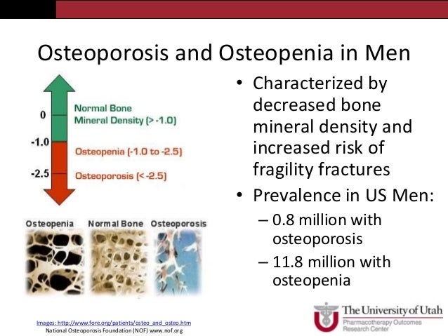 Are Tumescent Manhood Problems and Osteoporosis Linked