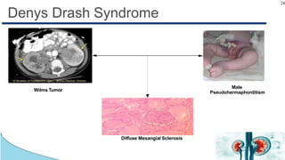 24
Denys Drash Syndrome
Diffuse Mesangial Sclerosis
Male
PseudohermaphorditismWilms Tumor
 