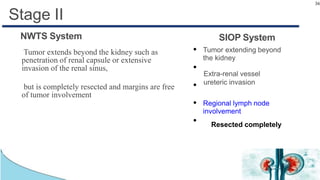 36
Stage II
SIOP System
●
Tumor extending beyond
the kidney
●
Extra-renal vessel
ureteric invasion●
●
Regional lymph node
involvement
●
Resected completely
NWTS System
Tumor extends beyond the kidney such as
penetration of renal capsule or extensive
invasion of the renal sinus,
but is completely resected and margins are free
of tumor involvement
 