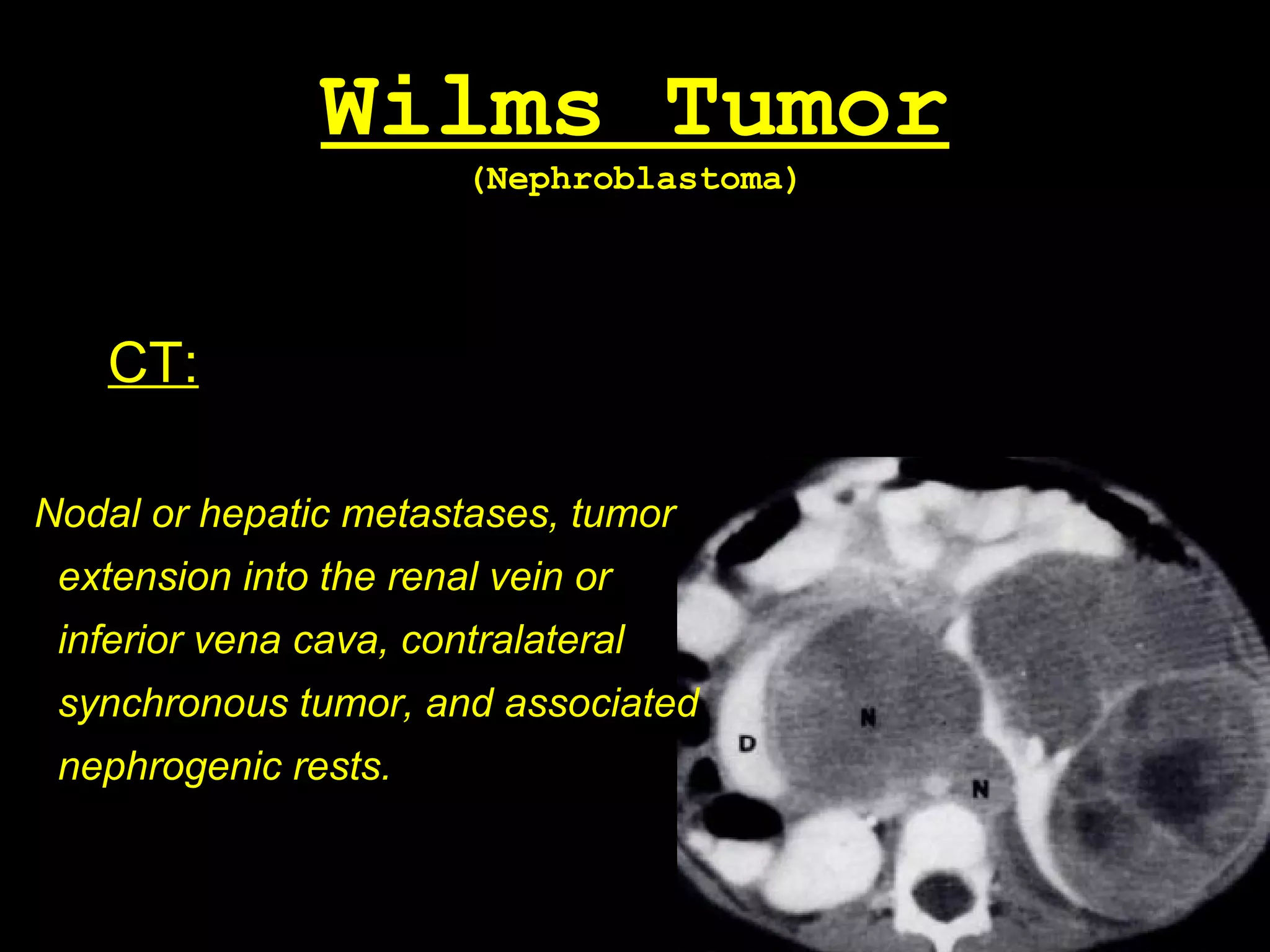 Wilms tumor | PPT