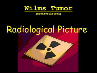 Wilms Tumor
(Nephroblastoma)
Radiological Picture
 