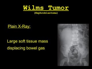 Wilms Tumor
(Nephroblastoma)
Plain X-Ray:
Large soft tissue mass
displacing bowel gas
 