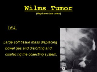 Wilms Tumor
(Nephroblastoma)
IVU:
Large soft tissue mass displacing
bowel gas and distorting and
displacing the collecting system.
 