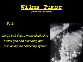 Wilms Tumor
(Nephroblastoma)
IVU:
Large soft tissue mass displacing
bowel gas and distorting and
displacing the collecting system.
 