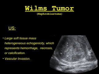 Wilms Tumor
(Nephroblastoma)
US:
• Large soft tissue mass
heterogeneous echogenicity, which
represents hemorrhage, necrosis,
or calcification.
• Vascular Invasion.
 