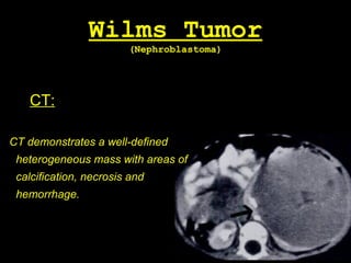 Wilms Tumor
(Nephroblastoma)
CT:
CT demonstrates a well-defined
heterogeneous mass with areas of
calcification, necrosis and
hemorrhage.
 