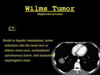 Wilms Tumor
(Nephroblastoma)
CT:
Nodal or hepatic metastases, tumor
extension into the renal vein or
inferior vena cava, contralateral
synchronous tumor, and associated
nephrogenic rests.
 