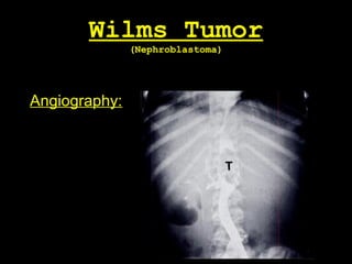 Wilms Tumor
(Nephroblastoma)
Angiography:
 