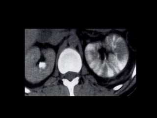Wilms tumor