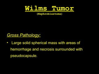 Wilms Tumor
(Nephroblastoma)
Gross Pathology:
• Large solid spherical mass with areas of
hemorrhage and necrosis surrounded with
pseudocapsule.
 