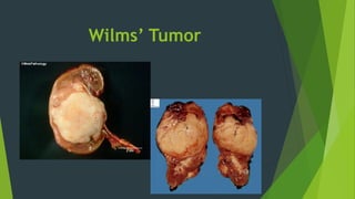 Wilms’ Tumor
 
