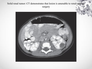 Solid renal tumor: CT demonstrates that lesion is amenable to renal-sparing
surgery
 