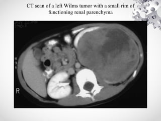 CT scan of a left Wilms tumor with a small rim of
functioning renal parenchyma
 