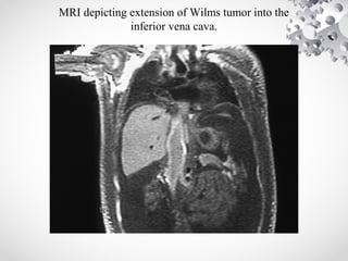 MRI depicting extension of Wilms tumor into the
inferior vena cava.
 