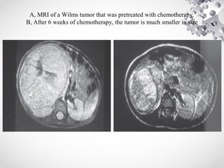 A, MRI of a Wilms tumor that was pretreated with chemotherapy.
B, After 6 weeks of chemotherapy, the tumor is much smaller in size
 