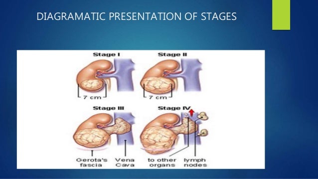 Wilms Tumor