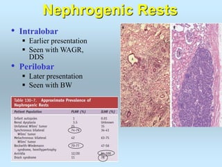 • Intralobar
 Earlier presentation
 Seen with WAGR,
DDS
• Perilobar
 Later presentation
 Seen with BW
Nephrogenic Rests
 