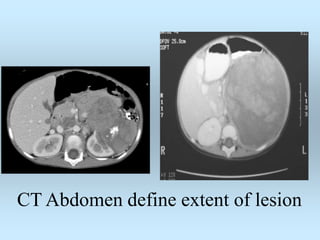 CT Abdomen define extent of lesion
 