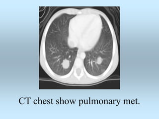 CT chest show pulmonary met.
 