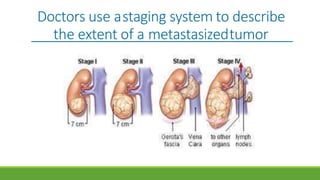 Doctors use astaging system to describe
the extent of a metastasizedtumor
 