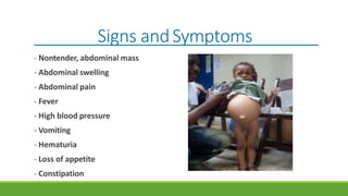 Signs andSymptoms
- Nontender, abdominal mass
- Abdominal swelling
- Abdominal pain
- Fever
- High blood pressure
- Vomiting
- Hematuria
- Loss of appetite
- Constipation
 