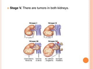  Stage V. There are tumors in both kidneys.
 