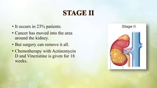 STAGE II
• It occurs in 23% patients.
• Cancer has moved into the area
around the kidney.
• But surgery can remove it all.
• Chemotherapy with Actinomycin
D and Vincristine is given for 18
weeks.
 