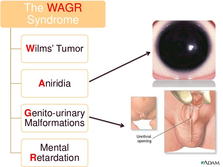 wagr syndrome In a report of a cohort of 61 patients with wagr syndrome, the oldest patient in whom wilms tumor developed was aged 7 years 3 months. wagr syndrome In a report of a cohort of 61 patients with wagr syndrome, the oldest patient in whom wilms tumor developed was aged 7 years 3 months.