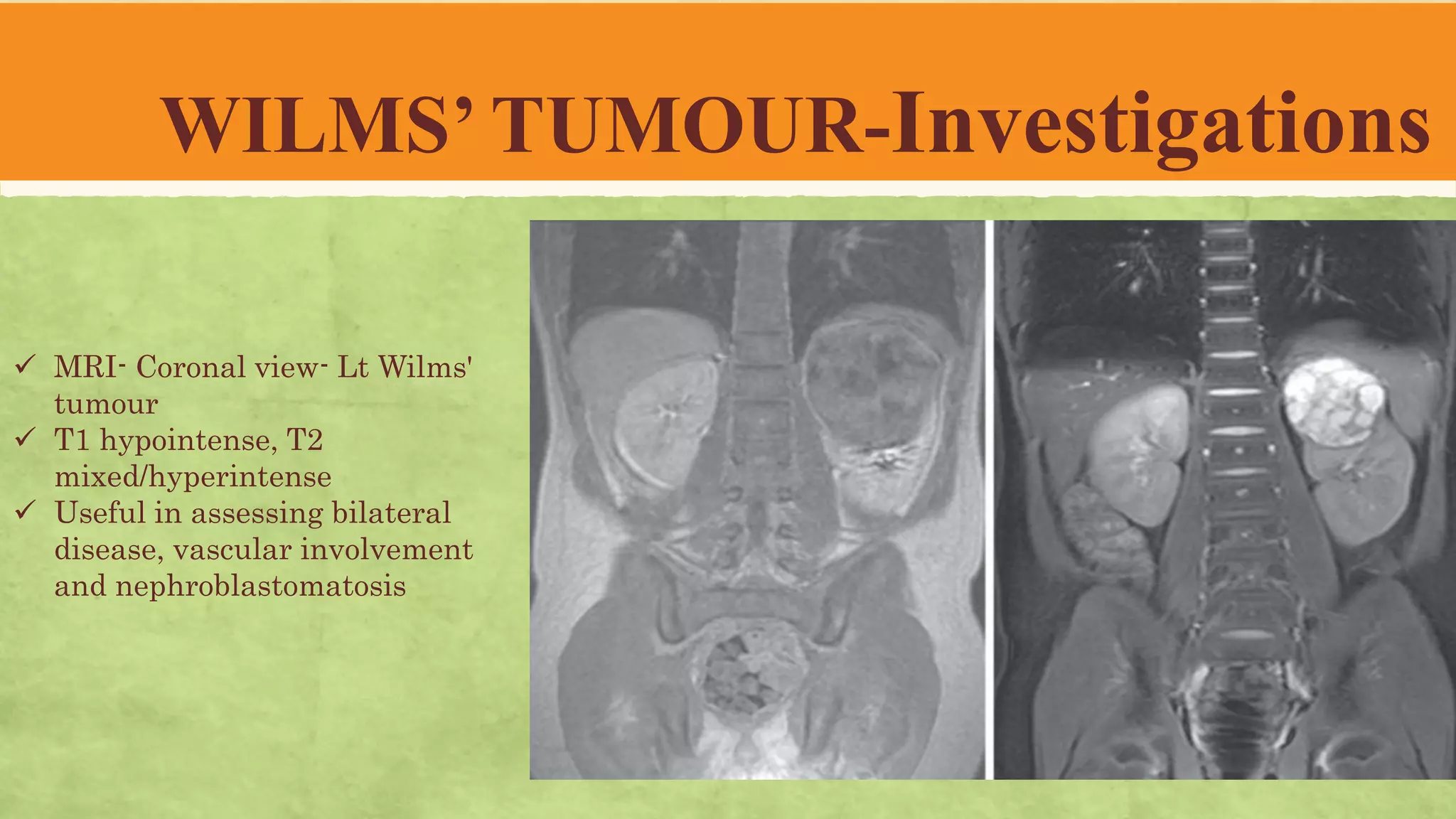 Wilms' tumour-- Pediatric Surgery | PPTX