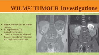 WILMS’ TUMOUR-Investigations
 MRI- Coronal view- Lt Wilms'
tumour
 T1 hypointense, T2
mixed/hyperintense
 Useful in assessing bilateral
disease, vascular involvement
and nephroblastomatosis
 