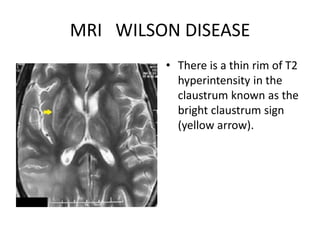 Wilson radiology | PPTX