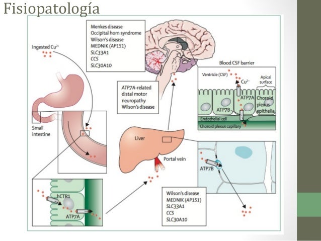 Enfermedad de alexander