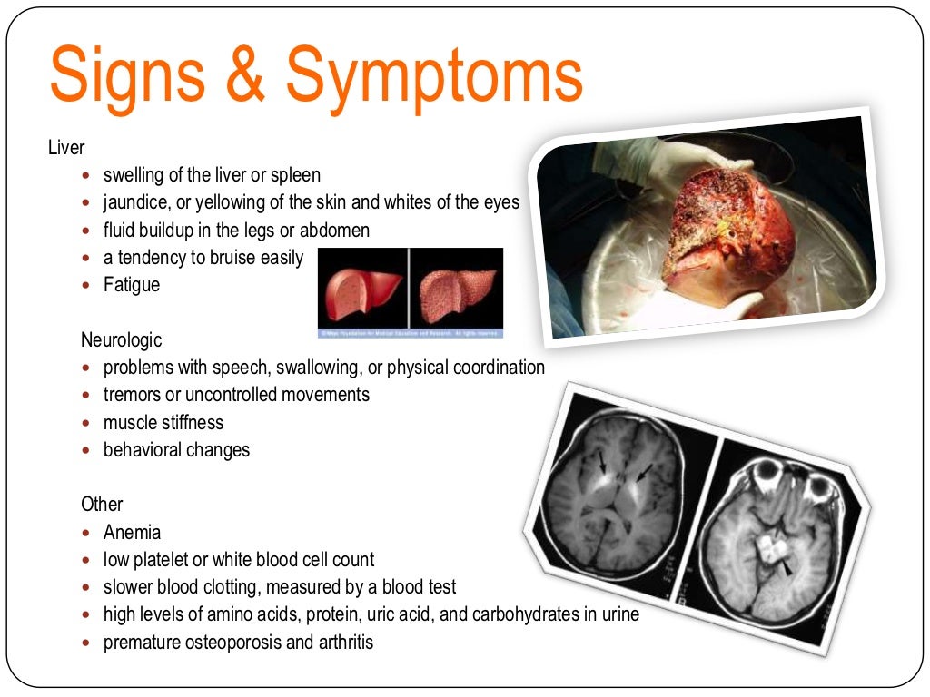 Wilson Disease Table 5