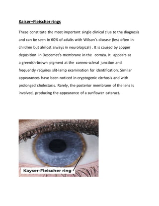 Kaiser–Fleischer rings
These constitute the most important single clinical clue to the diagnosis
and can be seen in 60% of adults with Wilson’s disease (less often in
children but almost always in neurological) . It is caused by copper
deposition in Descemet's membrane in the cornea. It appears as
a greenish-brown pigment at the corneo-scleral junction and
frequently requires slit-lamp examination for identification. Similar
appearances have been noticed in cryptogenic cirrhosis and with
prolonged cholestasis. Rarely, the posterior membrane of the lens is
involved, producing the appearance of a sunflower cataract.
 