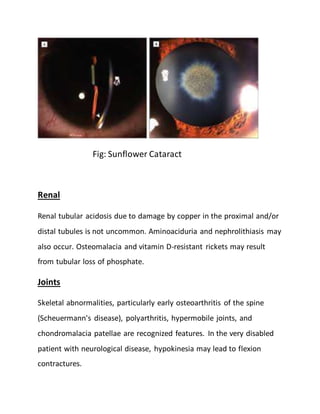Fig: Sunflower Cataract
Renal
Renal tubular acidosis due to damage by copper in the proximal and/or
distal tubules is not uncommon. Aminoaciduria and nephrolithiasis may
also occur. Osteomalacia and vitamin D-resistant rickets may result
from tubular loss of phosphate.
Joints
Skeletal abnormalities, particularly early osteoarthritis of the spine
(Scheuermann's disease), polyarthritis, hypermobile joints, and
chondromalacia patellae are recognized features. In the very disabled
patient with neurological disease, hypokinesia may lead to flexion
contractures.
 