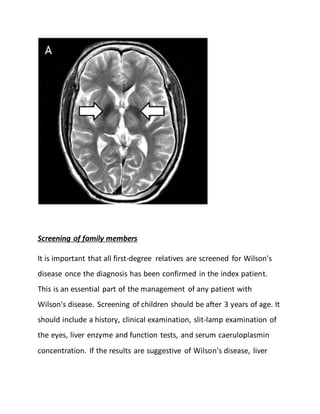 Screening of family members
It is important that all first-degree relatives are screened for Wilson's
disease once the diagnosis has been confirmed in the index patient.
This is an essential part of the management of any patient with
Wilson's disease. Screening of children should be after 3 years of age. It
should include a history, clinical examination, slit-lamp examination of
the eyes, liver enzyme and function tests, and serum caeruloplasmin
concentration. If the results are suggestive of Wilson's disease, liver
 